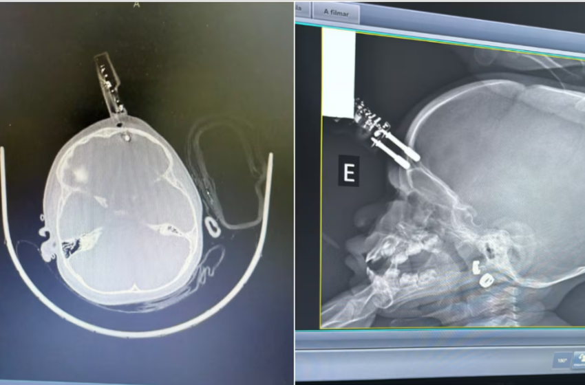  Queda doméstica provoca perfuração no crânio de bebê
